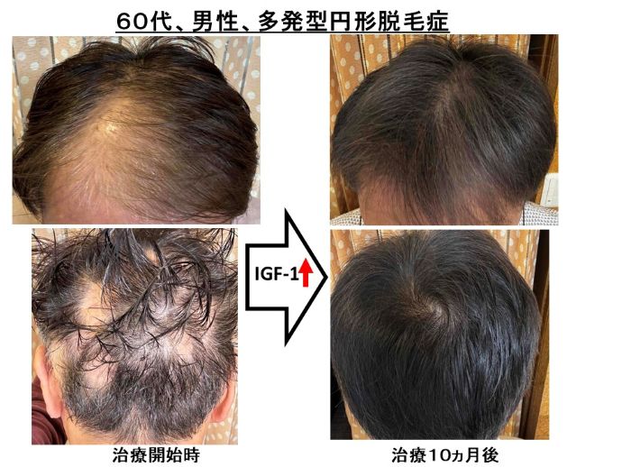 円形脱毛症　病院